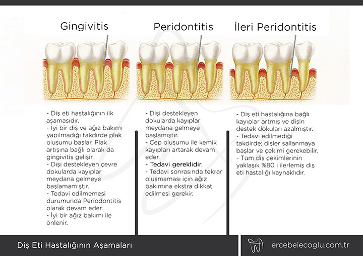 Diş eti hastalığı Gingivitis