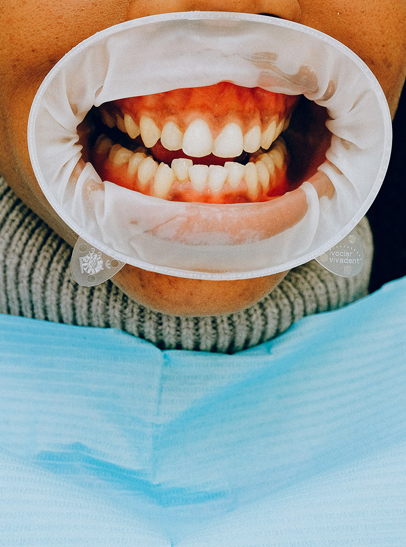 Diş Estetiğine Neden İhtiyaç Duyulur?