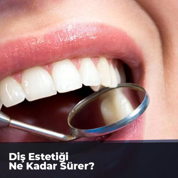 Diş Estetiği Ne Kadar Sürer?