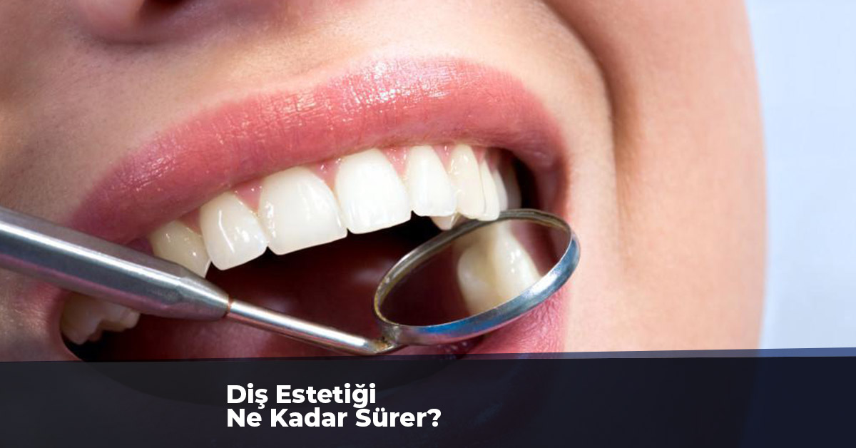 Diş Estetiği Ne Kadar Sürer?