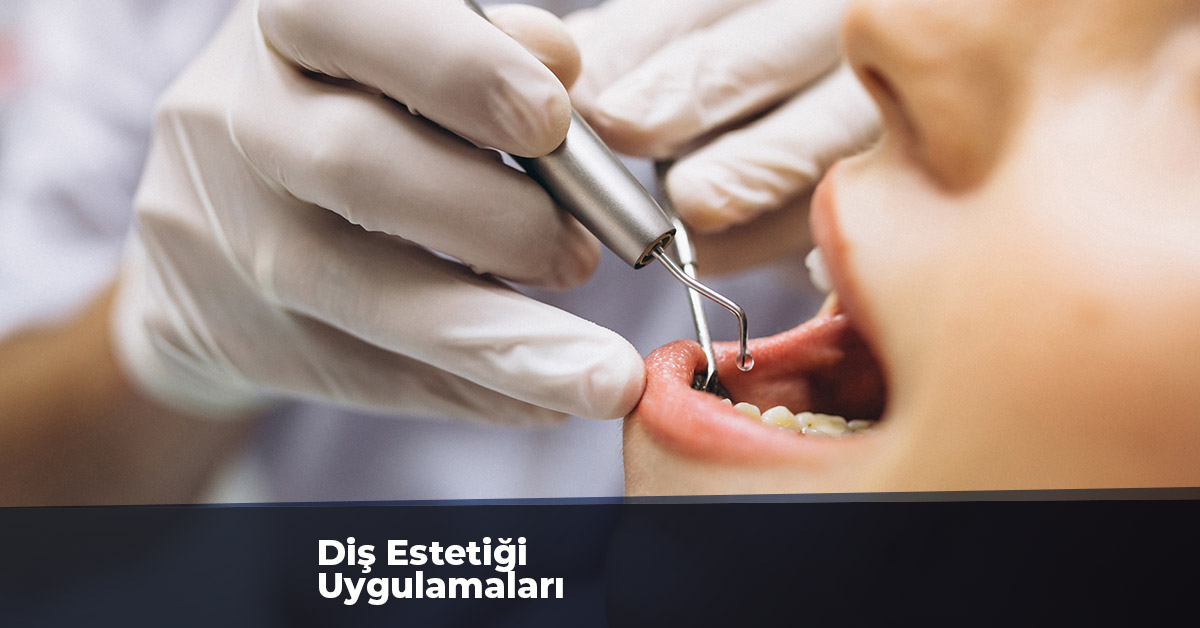 Diş Estetiği Uygulamaları