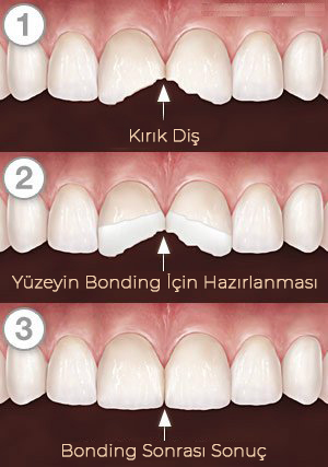 Bonding Nedir?