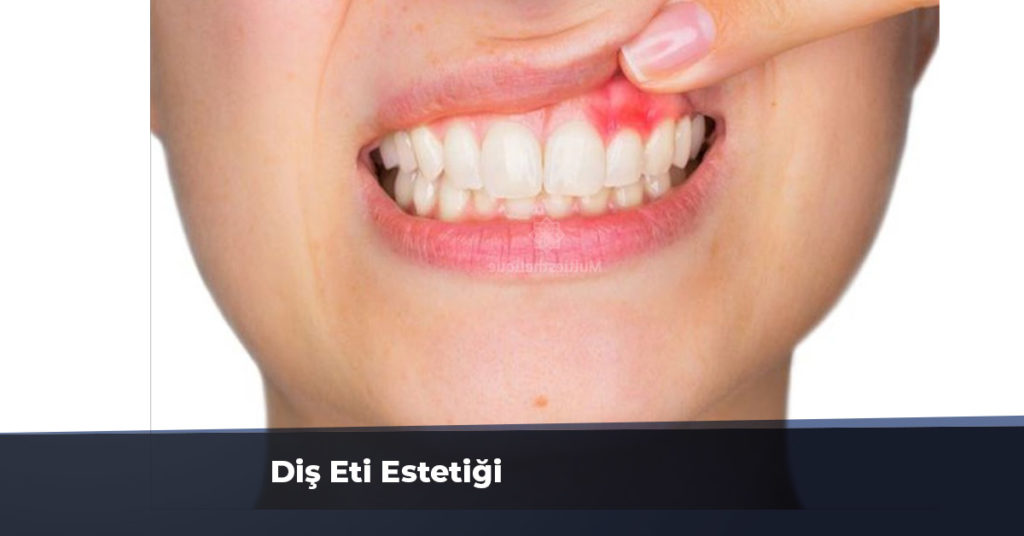 Diş Eti Estetiği Ankara