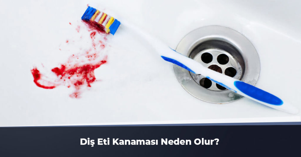 diş eti kanaması neden olur