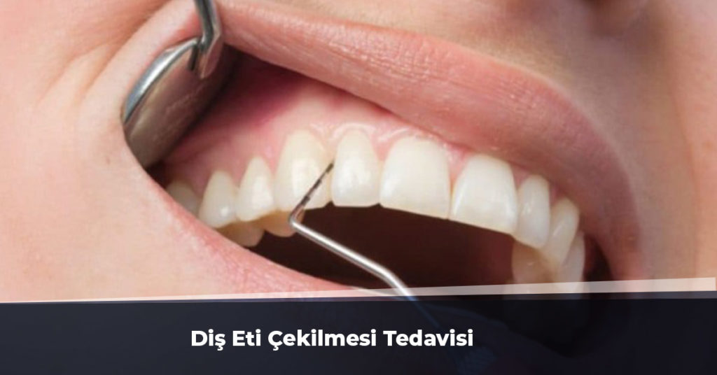 diş eti çekilmesi tedavisi