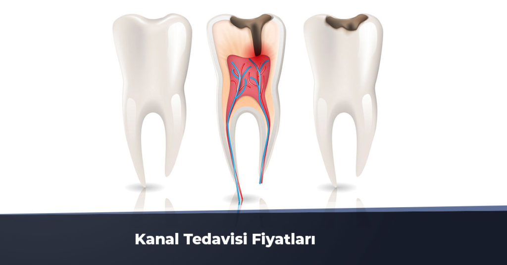 diş kanal tedavisi fiyatları