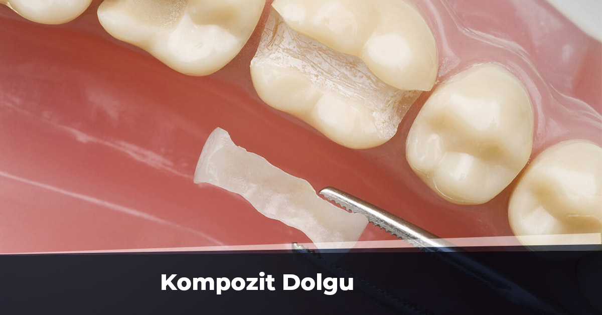 kompozit dolgu