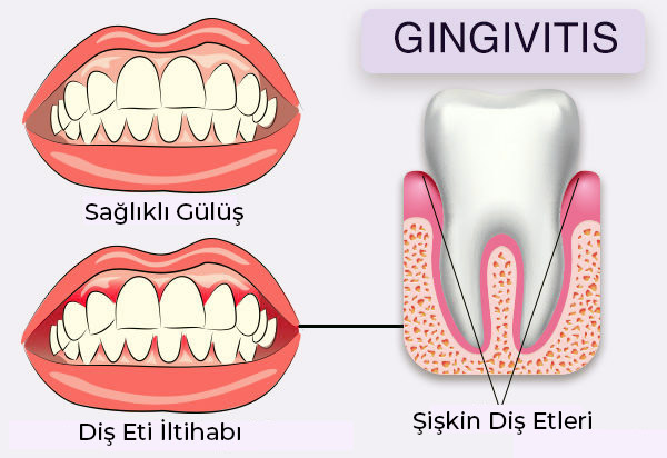 Diş Eti İltihabı