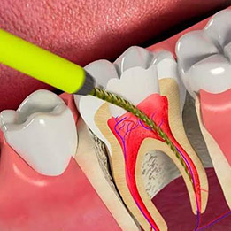 Endodonti (Kanal Tedavisi)