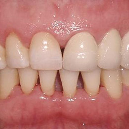 Periodontoloji (Diş Eti Tedavisi)