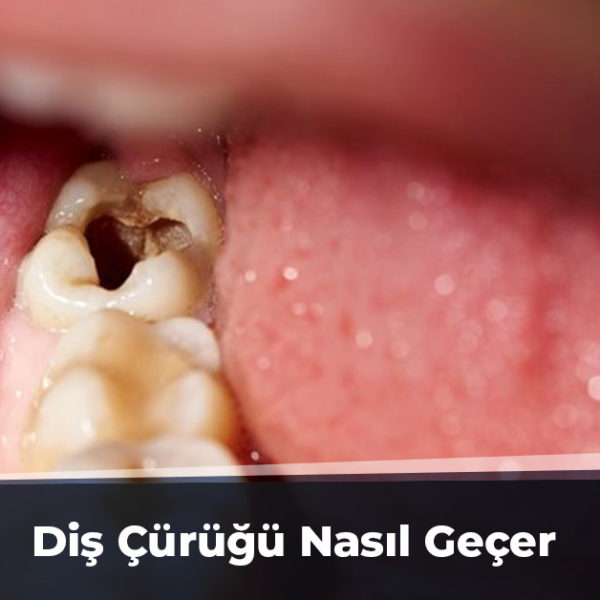 Diş Çürüğü Nasıl Geçer Ankara