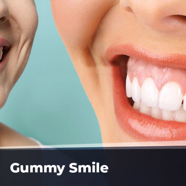 gummy smile tedavisi