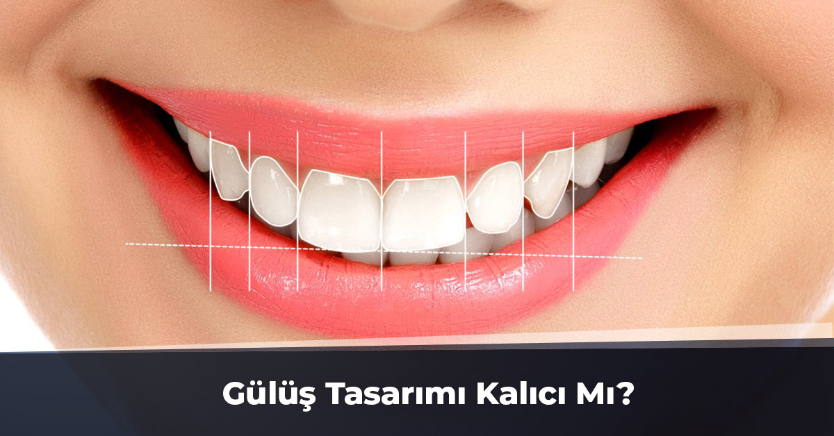 Gülüş Tasarımı Kalıcı mı? Hangi İşlemleri İçerir?