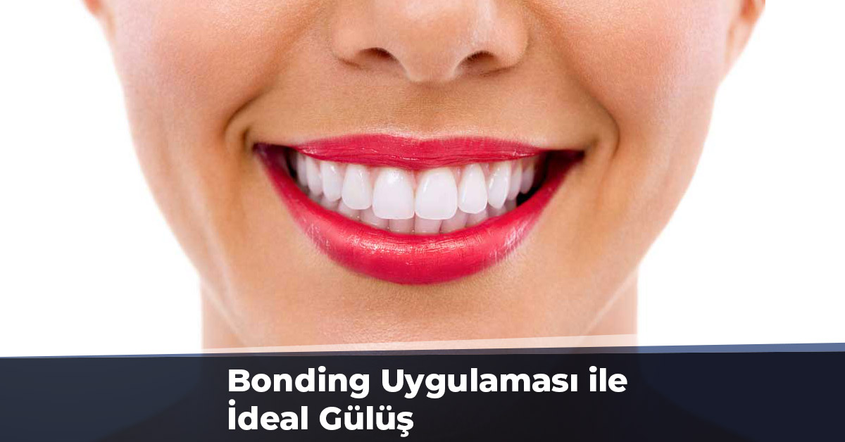 Bonding Uygulaması ile İdeal Gülüş