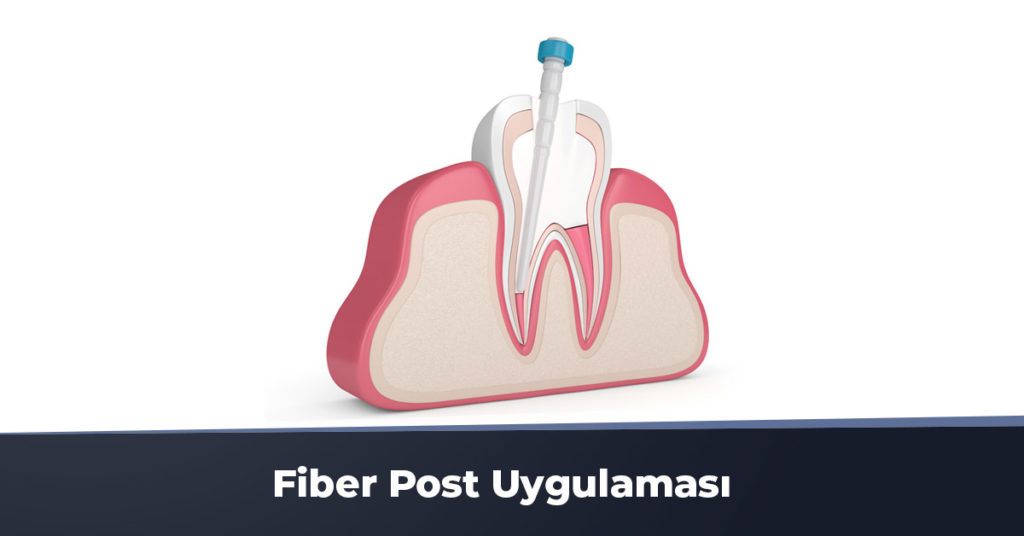 Fiber Post Uygulaması Ankara