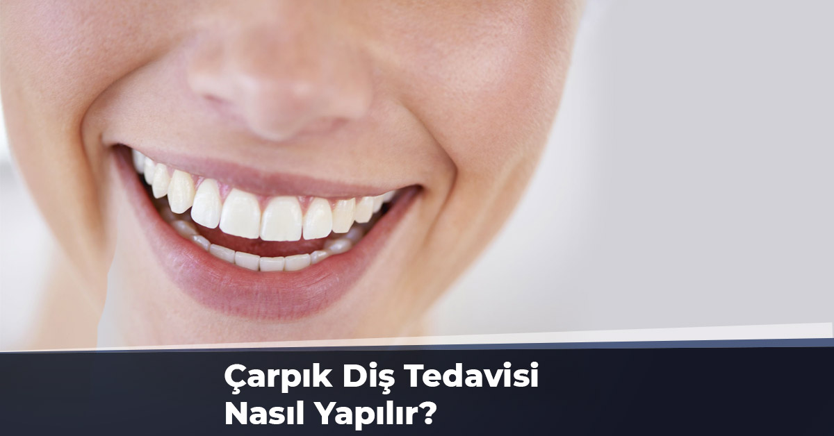 Çarpık Diş Tedavisi Nasıl Yapılır?