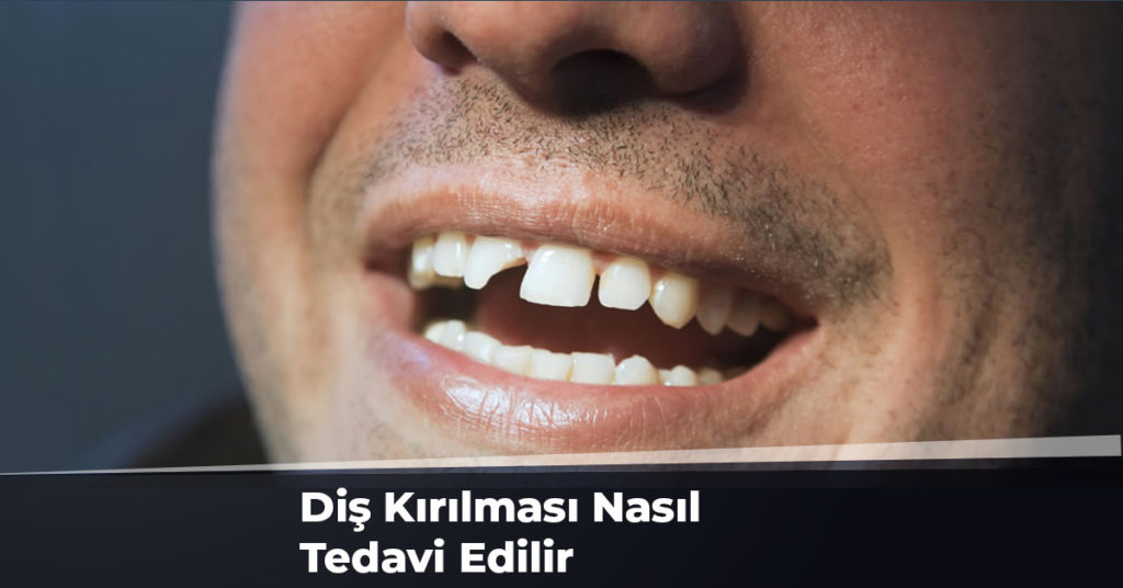 Diş Kırılması Nasıl Tedavi Edilir?