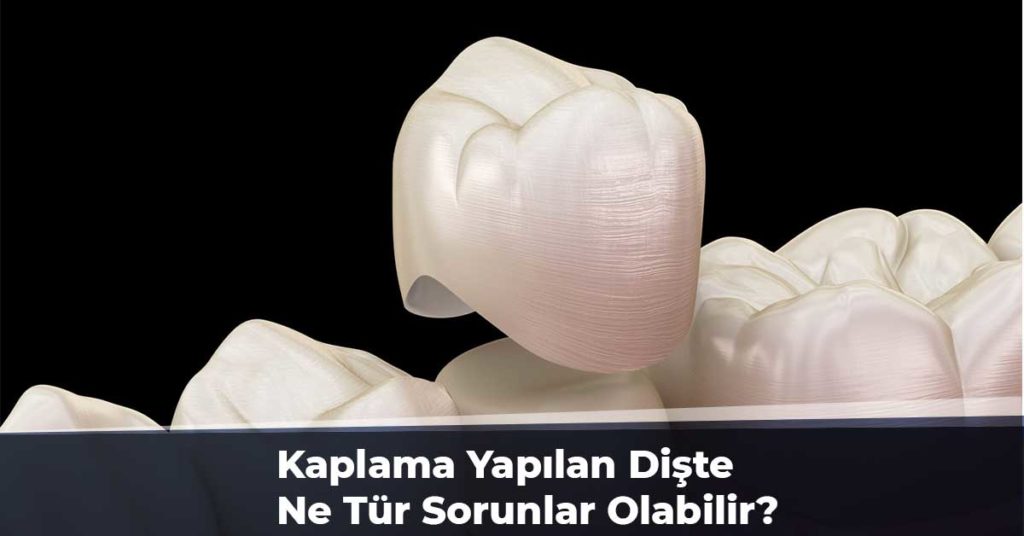 Kaplama Yapılan Dişte Ne Tür Sorunlar Olabilir?