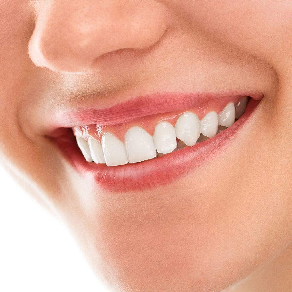 Ankara Diş Beyazlatma