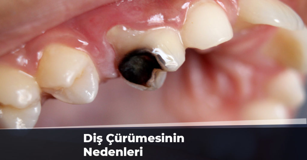 Diş Çürümesinin Nedenleri