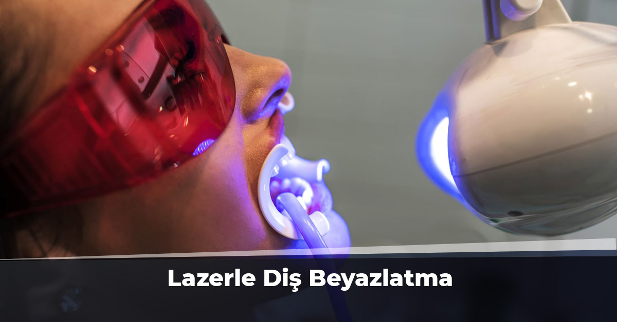 Lazerle Diş Beyazlatma