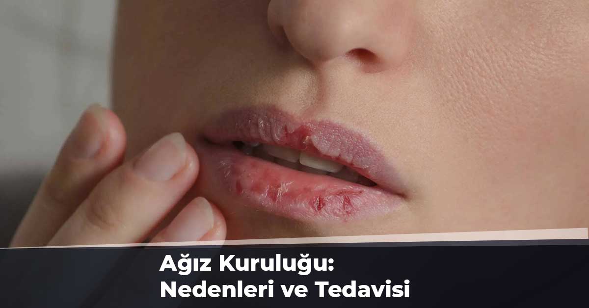 Ağız Kuruluğu: Nedenleri ve Tedavisi