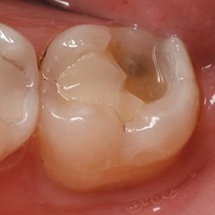 Diş Dolgusu Düşerse Ne Yapılmalı?