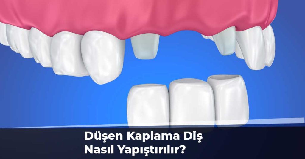 Düşen Kaplama Diş Nasıl Yapıştırılır?