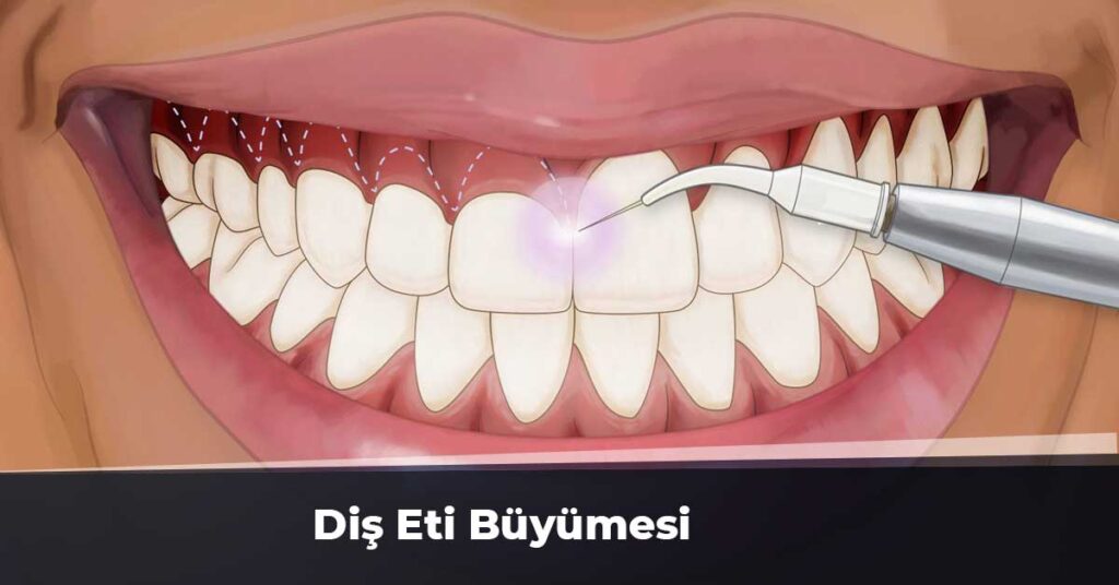 Diş Eti Büyümesi