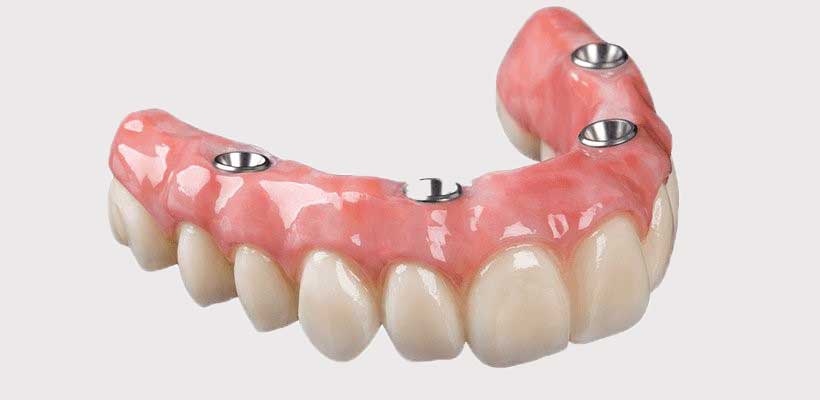 Yeni Nesil Diş Protezi