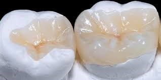 Restoratif Diş Tedavisi Nedir? 2 İnley ve Onley Dolgu Nasıl Yapılır?