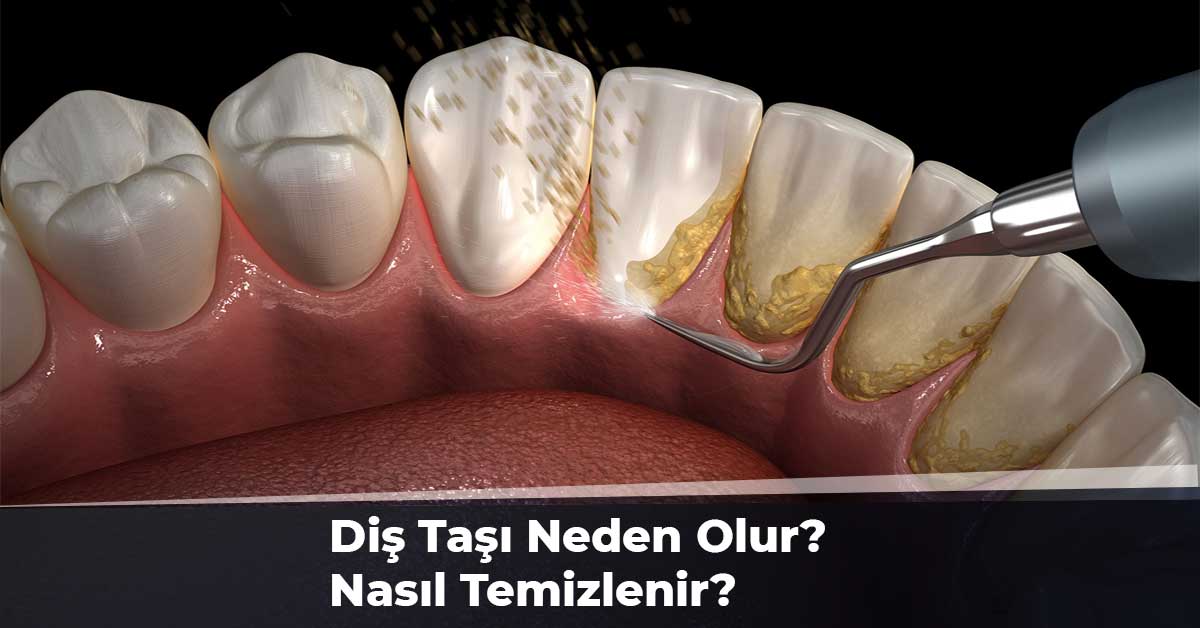 Diş Taşı Neden Olur?