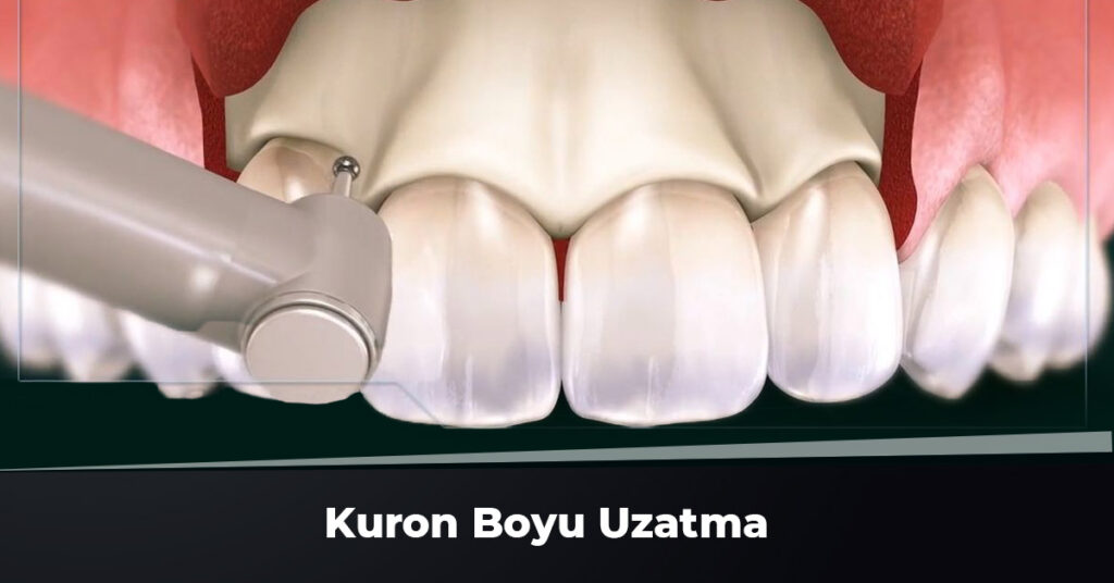 Kuron Boyu Uzatma