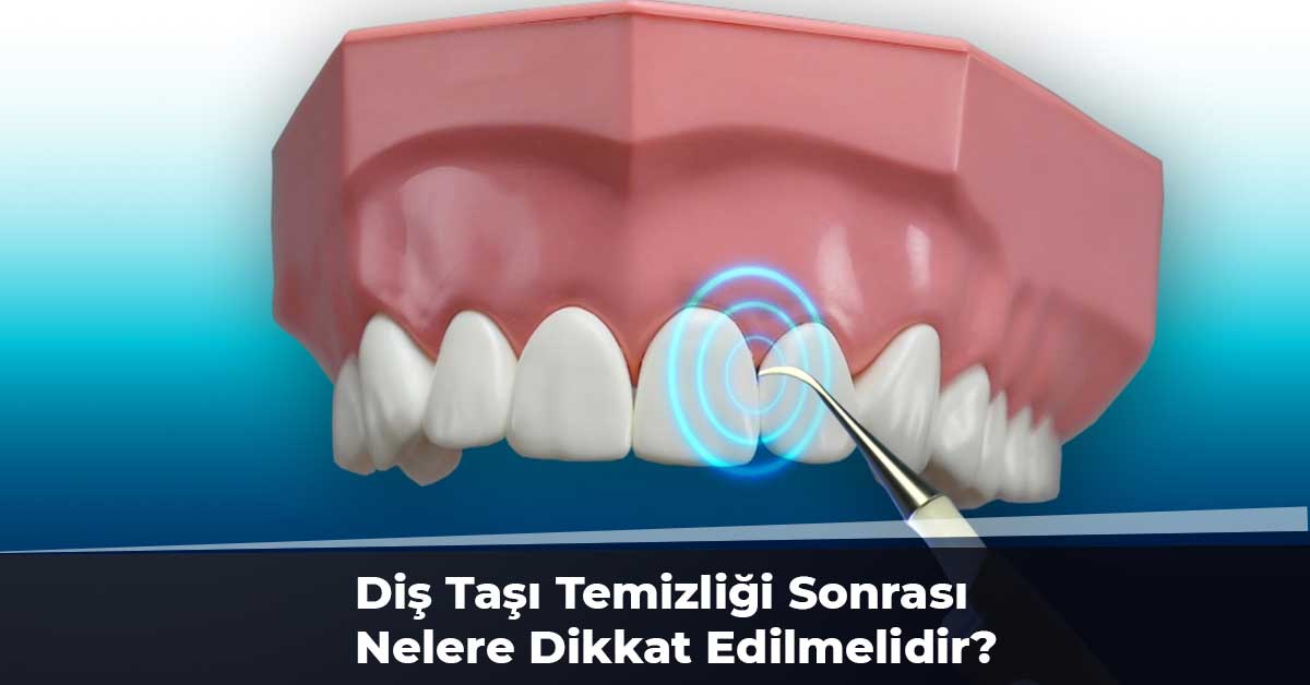 Diş Taşı Temizliği Sonrası Nelere Dikkat Edilmelidir?