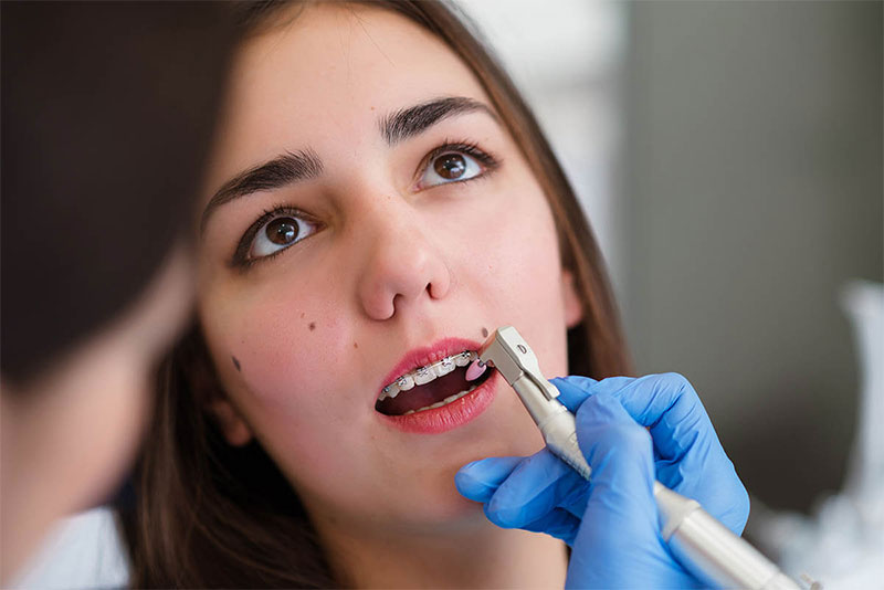 Diş Taşı Temizliği Zararlı mı?