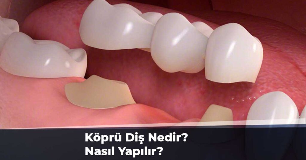 Köprü Diş Nasıl Yapılır?