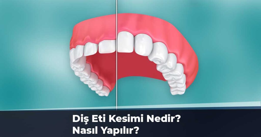 Diş Eti Kesimi Nedir? Nasıl Yapılır?