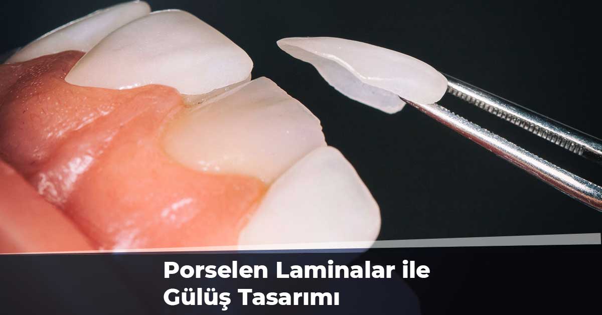 Porselen Laminalar