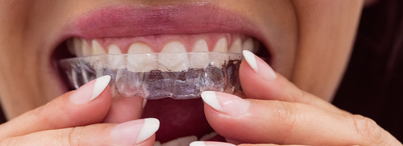 Invisalign Ankara