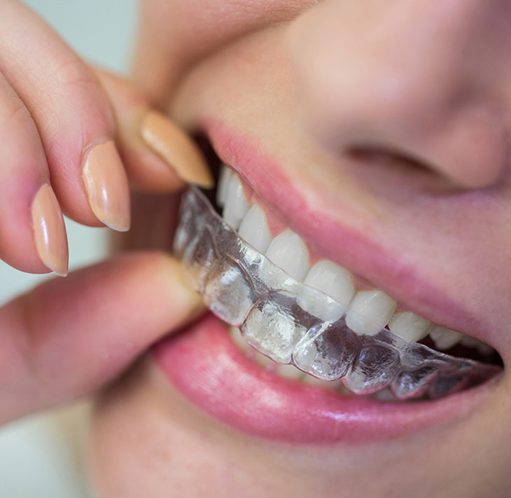Invisalign Tedavisi Sonrası Dikkat Edilmesi Gerekenler