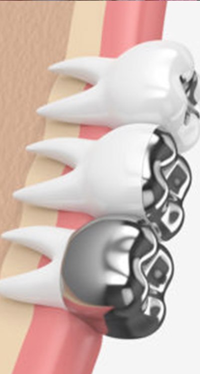 Amalgam Dolgu İçindeki Cıva Zararlı Mıdır?
