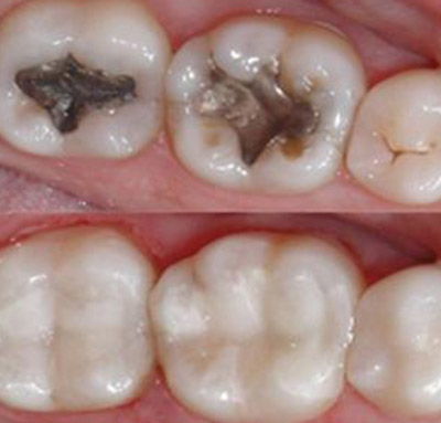 Amalgam Dolgu Dezavantajları