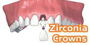 Zirconia Crowns