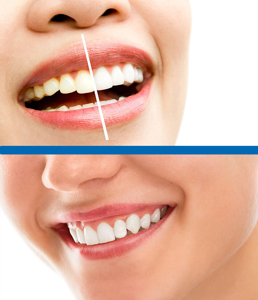 Laminate Veneer Fiyat Listesi Lamine Diş Fiyatları 2021