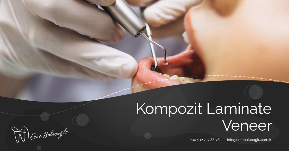 Kompozit Laminate Veneer