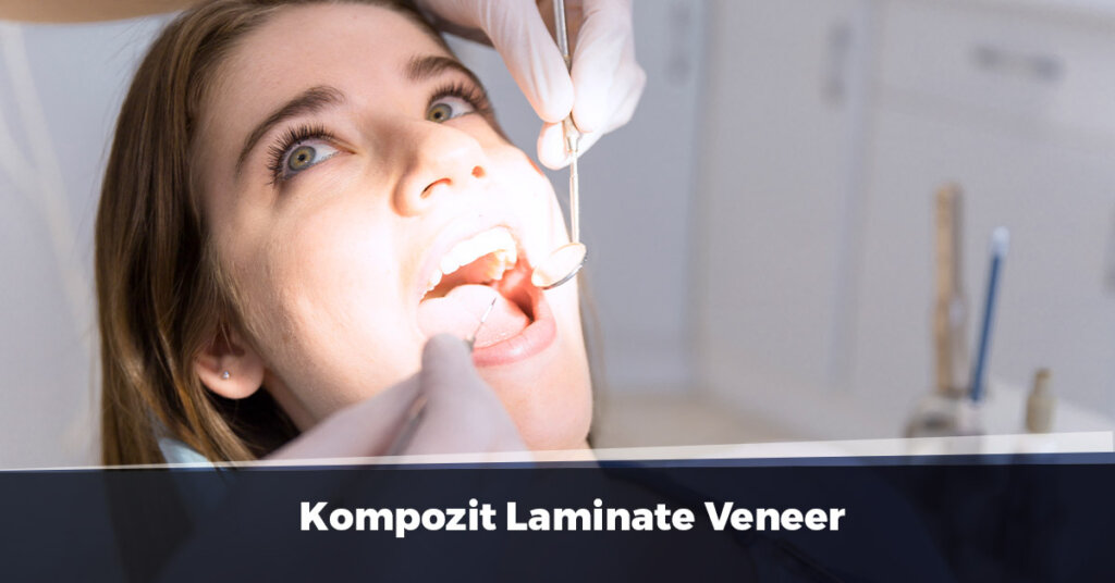 Kompozit Laminate Veneer Kompozit Lamina Özellikleri