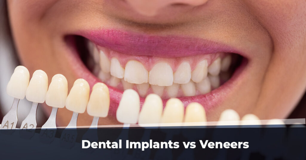 Dental Implants vs Veneers
