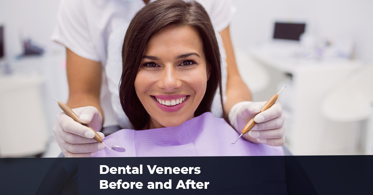Dental veneers before and after