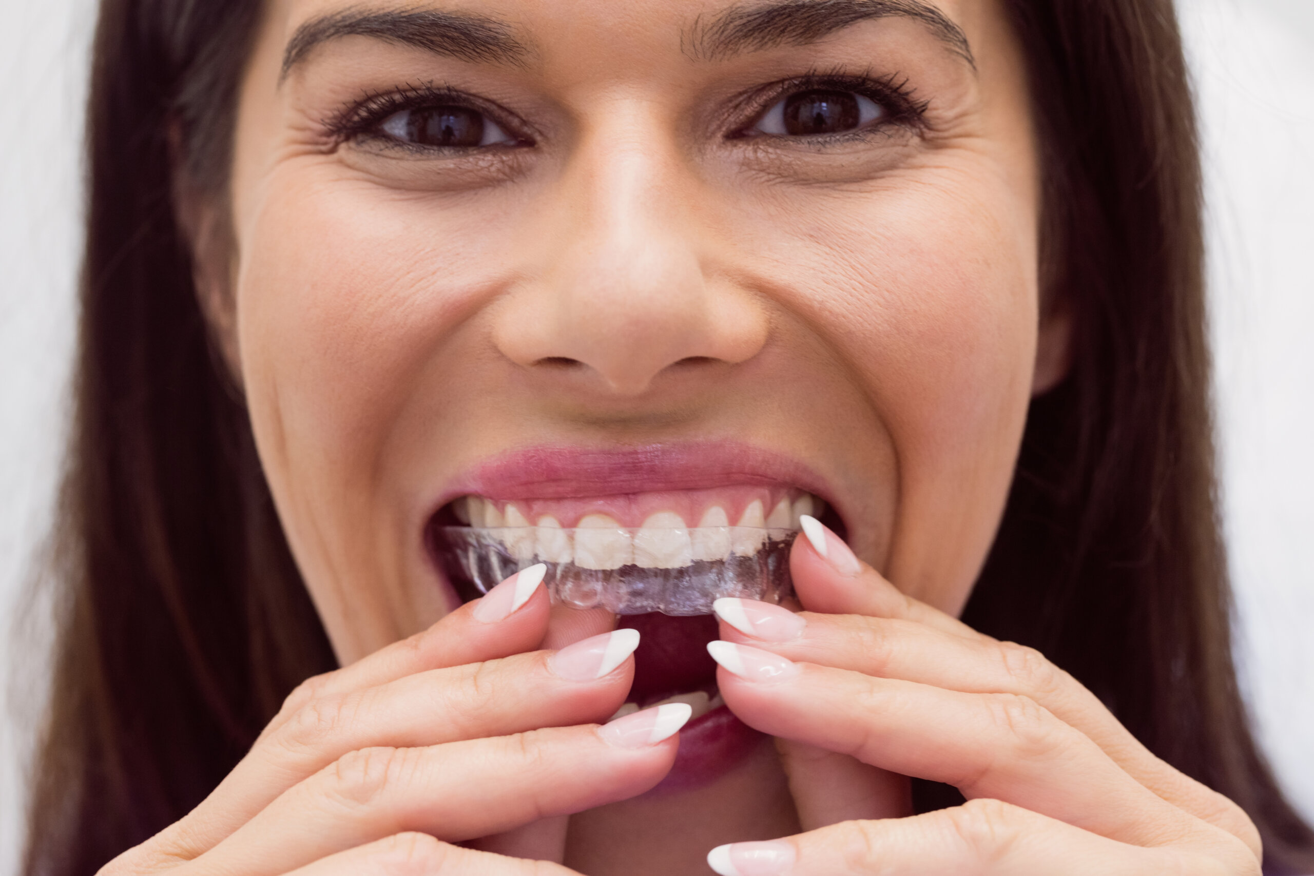 What is invisalign?