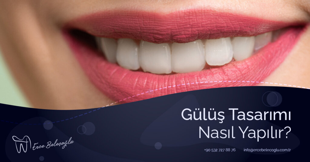Gülüş Tasarımı Nasıl Yapılır?